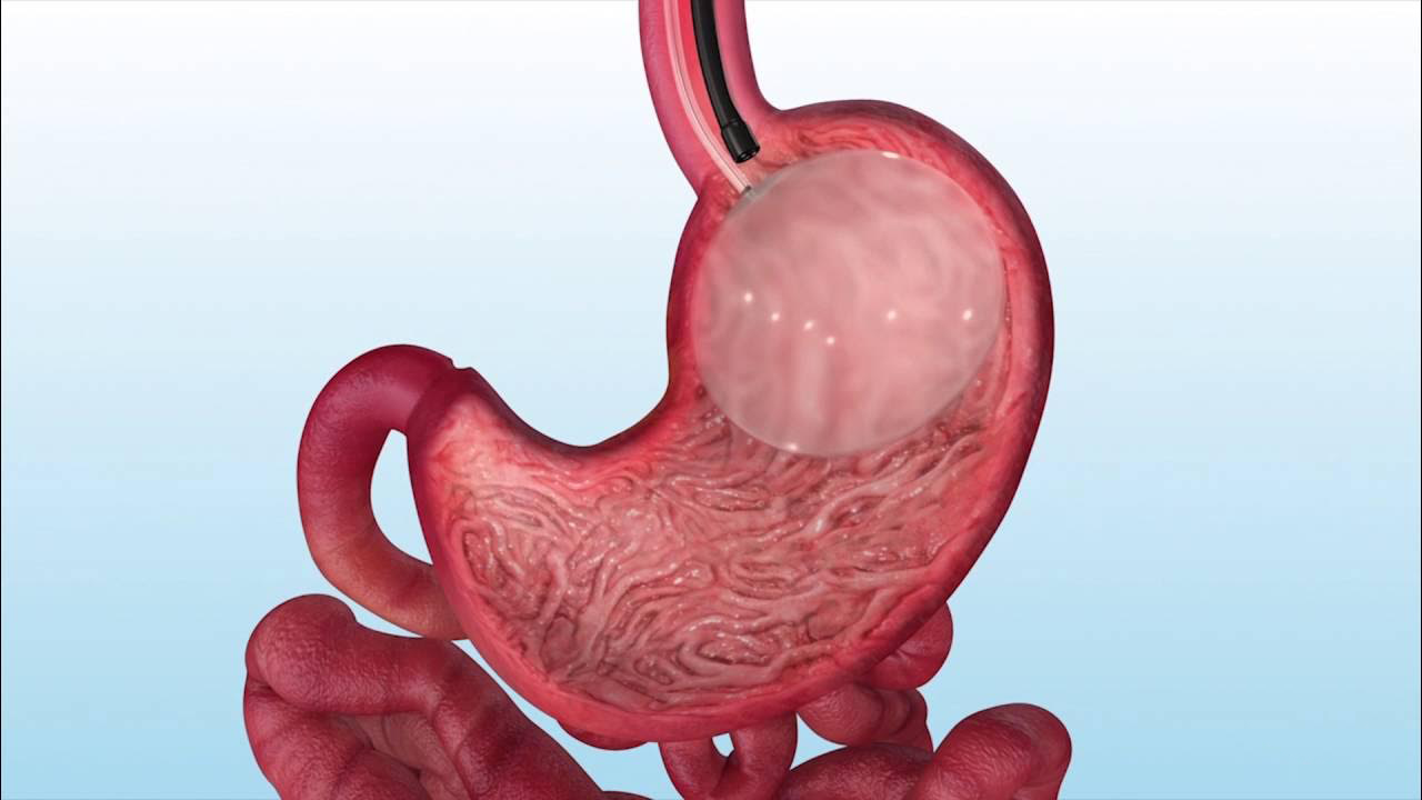 Gastric Balloon