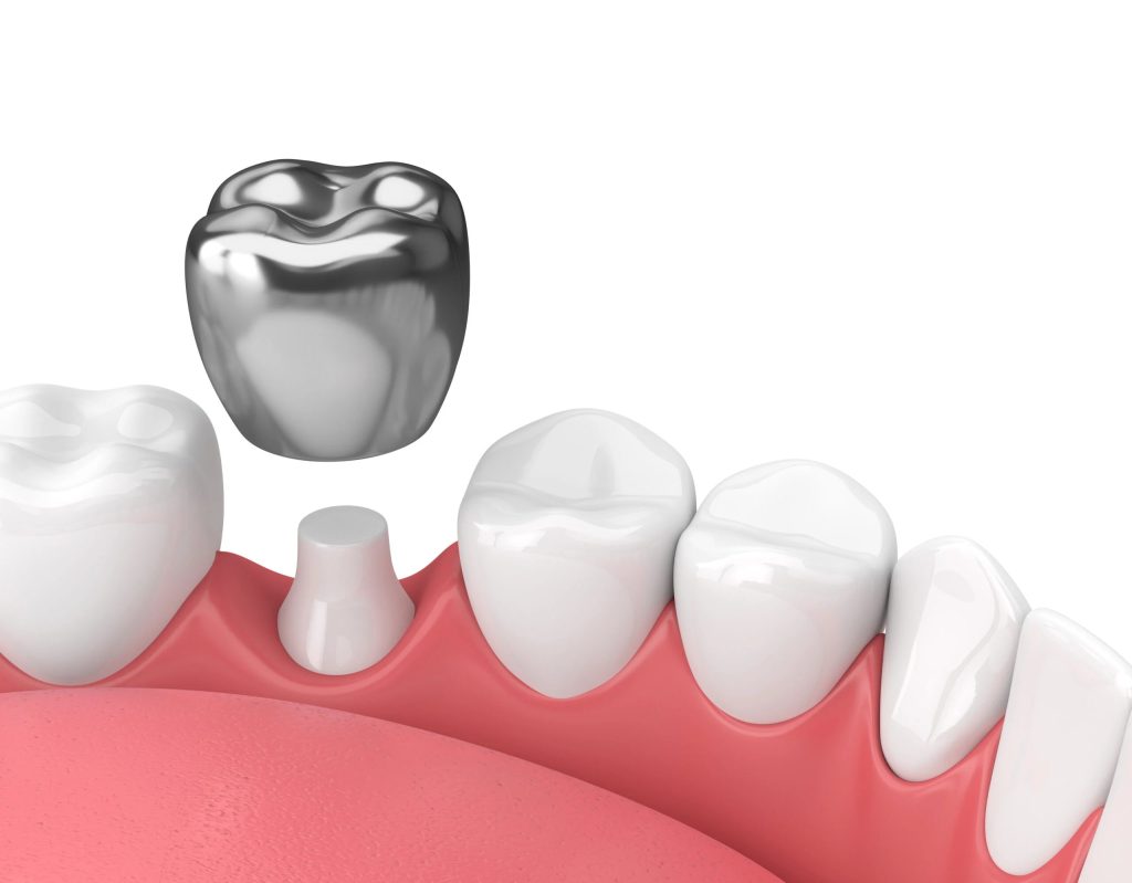 Dental metal Crowns